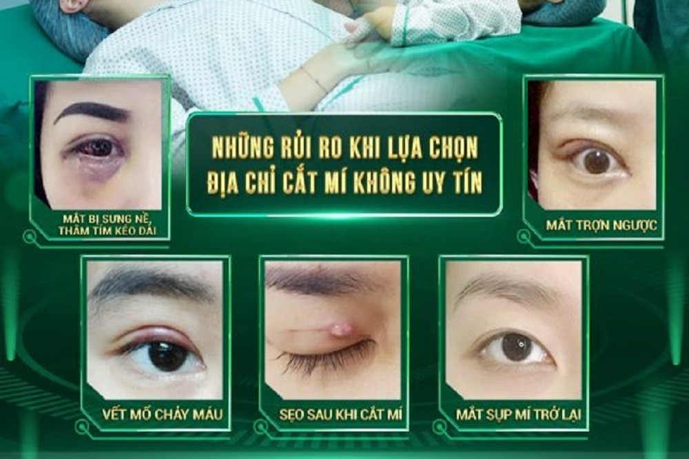 [CẢNH BÁO] Những tác hại của cắt mí mắt hỏng và cách khắc phục không gây biến chứng