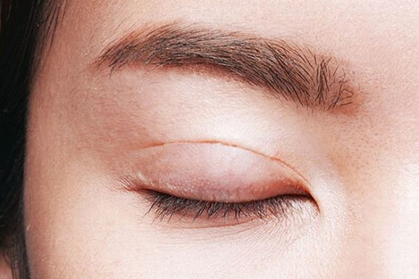 tác hại cắt mí mắt