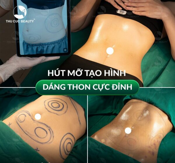 Hút mỡ toàn thân giá bao nhiêu tiền? 3 Hút mỡ an toàn, hiệu quả cao bằng công nghệ Vaser Lipo