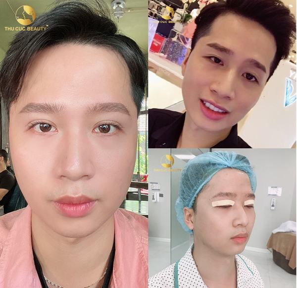 Bóc mỡ mí mắt trên giá bao nhiêu? Cách giảm mỡ mí mắt 15 the nao la mat phuong 21