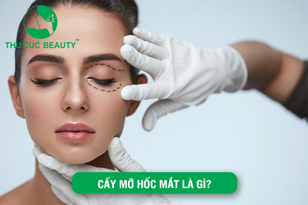 Cấy mỡ hốc mắt là gì?