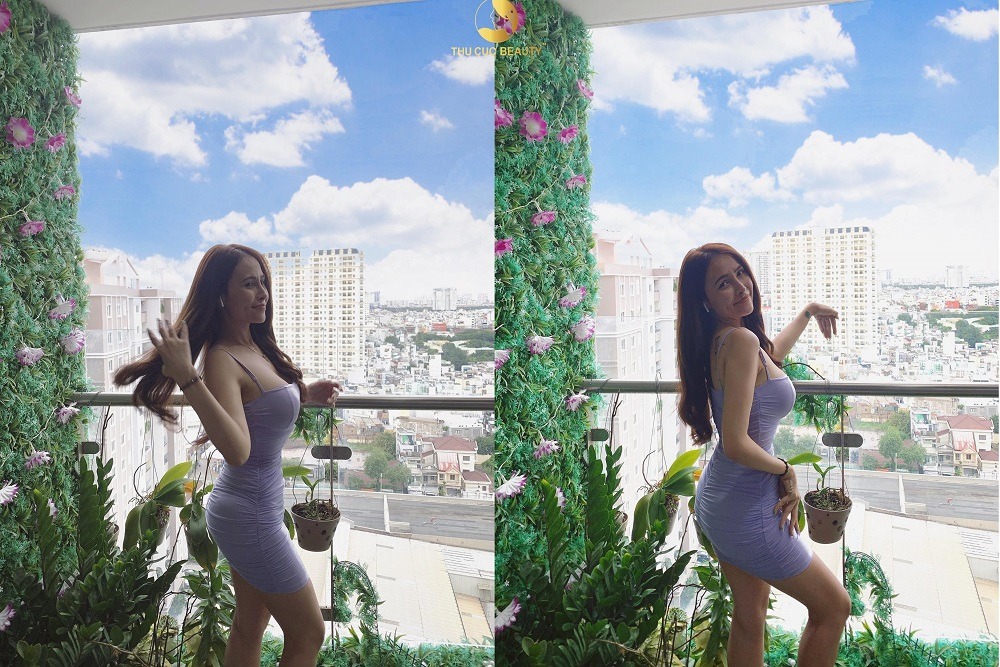 Cấy mỡ mông giữ được bao lâu?