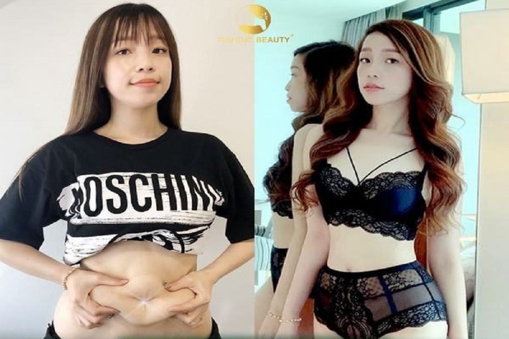 Tạo hình thành bụng giá bao nhiêu tại Thu Cúc? Có nguy hiểm không?