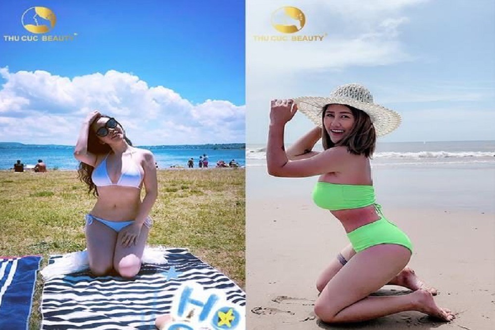 Hút mỡ hông giá bao nhiêu? 4 yếu tố quyết định