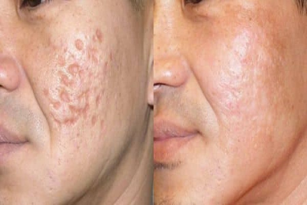 Thẩm mỹ trị sẹo lõm bao nhiêu tiền?