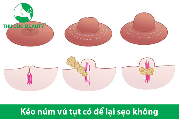 Kéo núm vú tụt có để lại sẹo không?