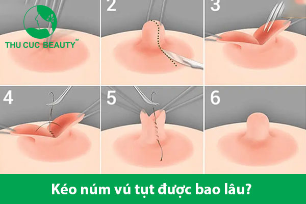 Kéo núm vú tụt được bao lâu? Có vĩnh viễn không?
