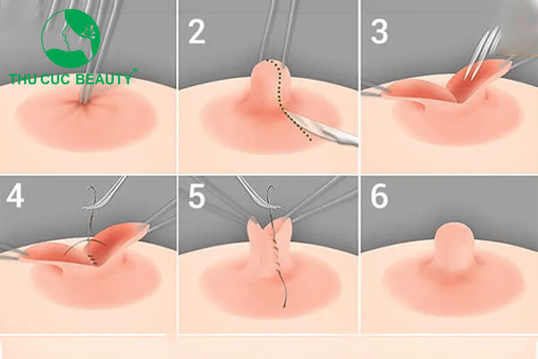 Kéo núm vú tụt tốt không? Có ảnh hưởng gì không?