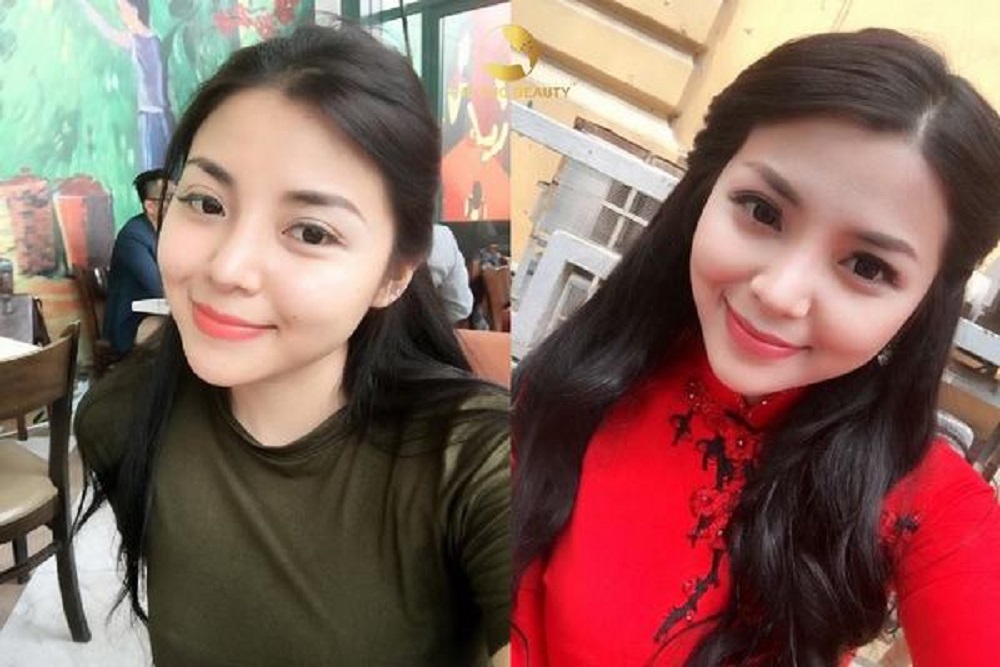 Cách làm thon gọn mặt sau sinh hiệu quả và an toàn