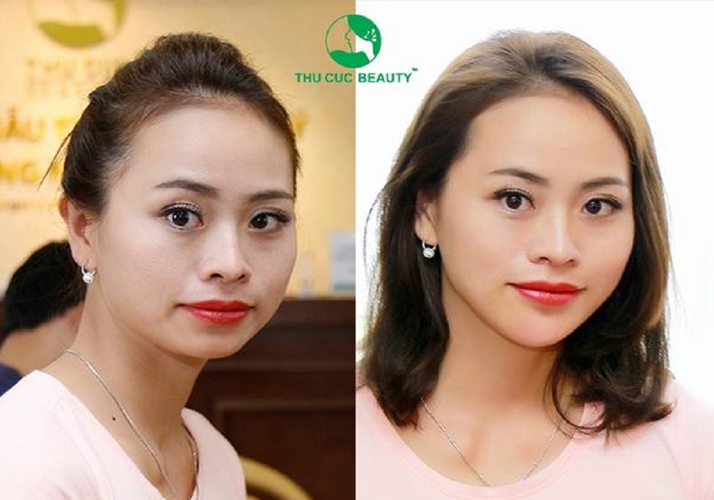 Mặt nọng là gì? Cách làm thon gọn mặt nọng hiệu quả nhất hiện nay