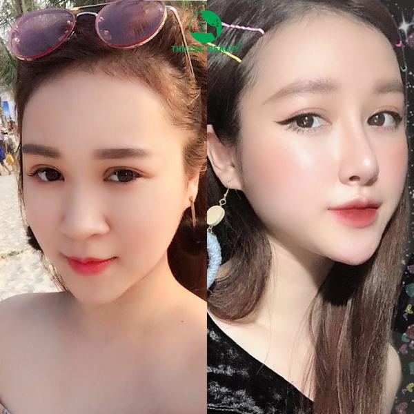 Thu gọn cánh mũi bằng phương pháp nội soi là gì? Có tốt không? 1 tang vang 1