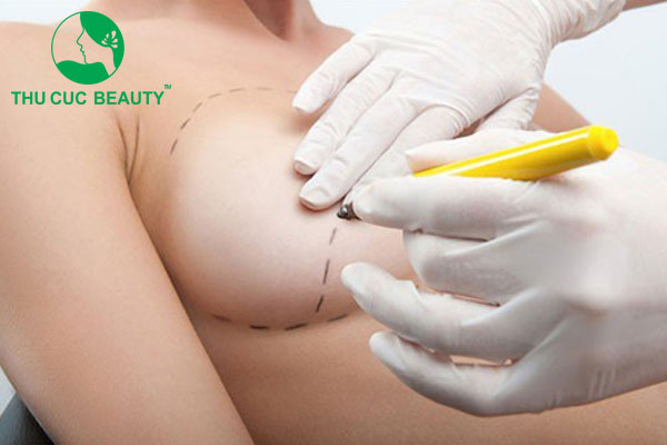 Treo ngực sa trễ bằng chỉ có tốt không?