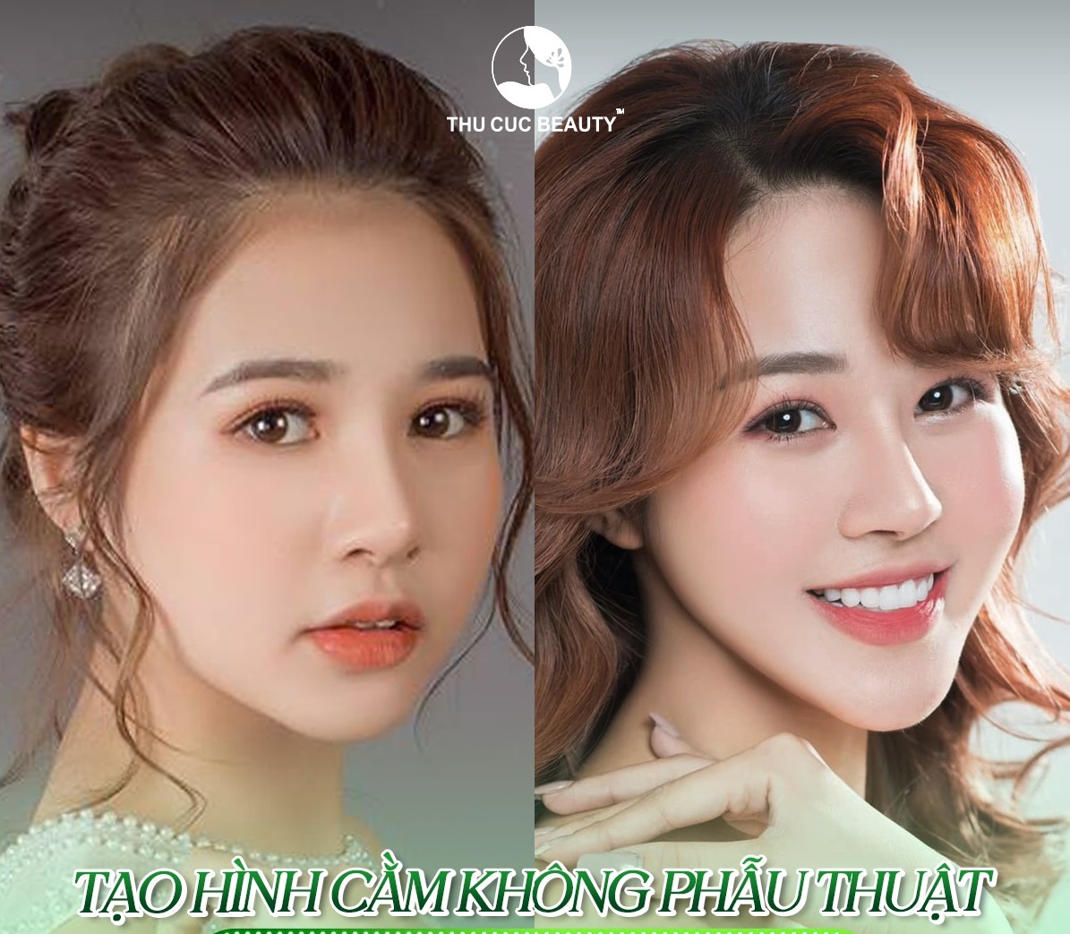 Phương pháp làm thon gọn mặt bằng Filler