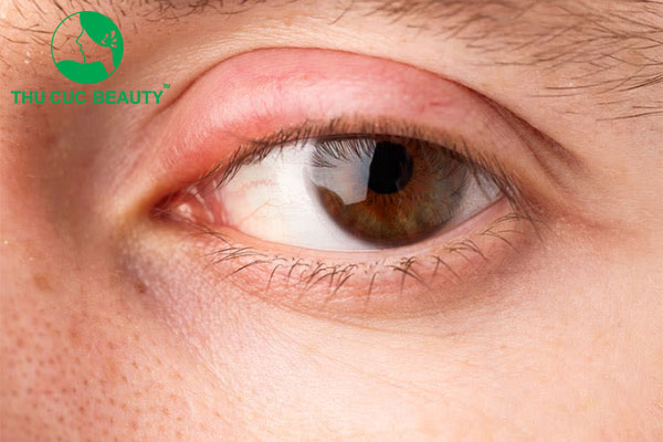 Mẹo giảm sưng sau cắt mí mắt và 7 lưu ý cần biết
