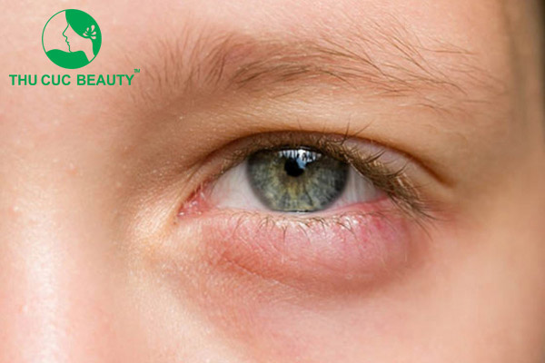 Cắt mí mắt hỏng bao lâu sửa lại được?