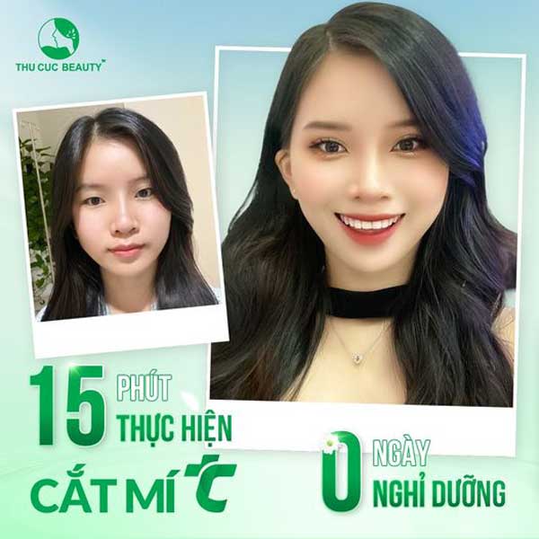 Cắt mí mắt dưới: Hướng dẫn A-Z về phương pháp trẻ hóa đôi mắt