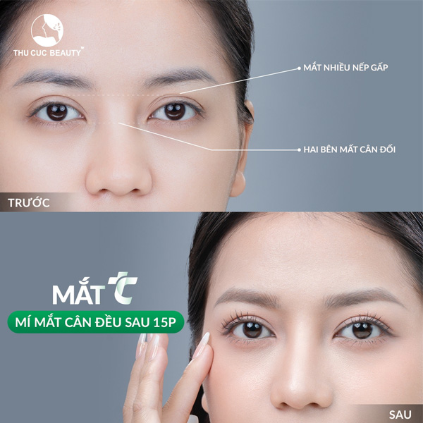 Phẫu Thuật Cắt Mí Mắt | Mắt TC | Chỉ Định | Quy Trình