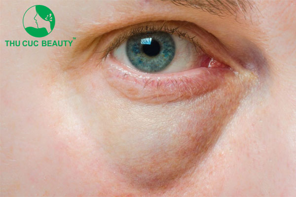 Lấy mỡ bọng mắt bao lâu thì lành
