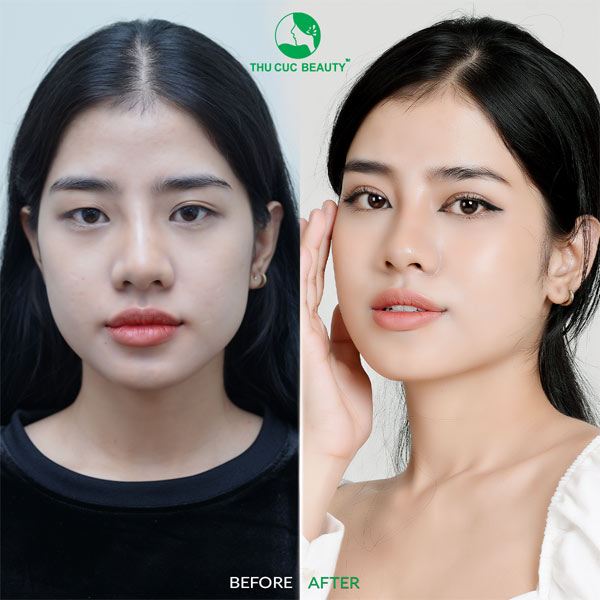 Cắt mí có làm mắt to hơn không