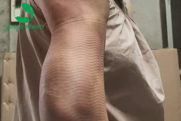 Hút mỡ bắp tay bị lồi lõm