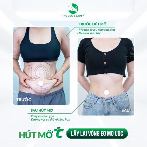 Hút mỡ bụng bao lâu hồi phục hoàn toàn? Bí quyết chăm sóc hiệu quả