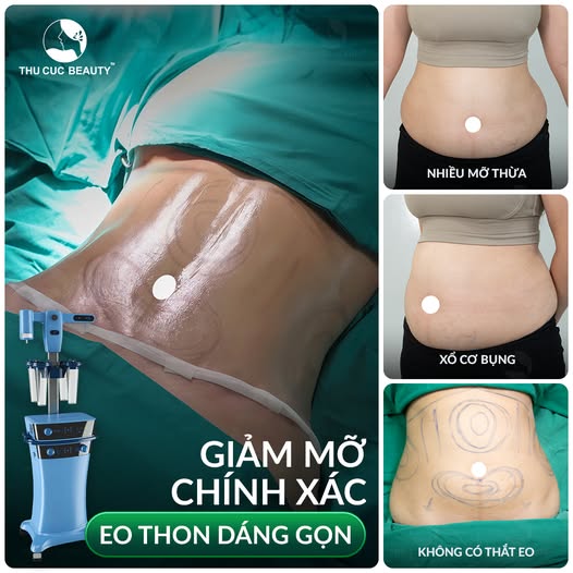 Hút Mỡ TC - Hút Mỡ Bằng Công Nghệ Vaser Lipo 5 hut mo cong nghe cao