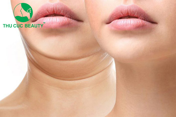 Hút mỡ nọng cằm nguy hiểm không?