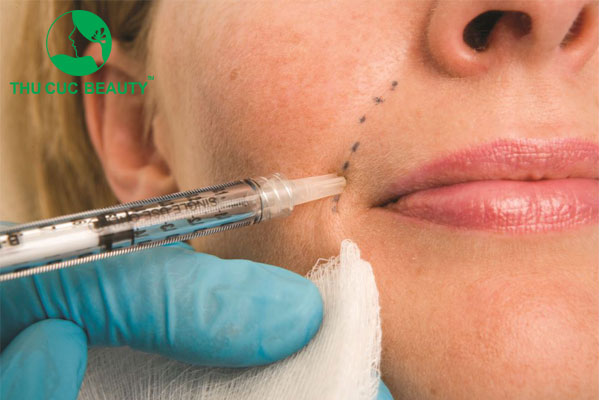 Có nên tiêm rãnh cười không? Lưu ý khi thực hiện