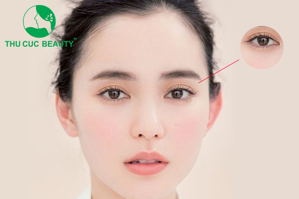 Cắt mí giọt lệ Trung Hoa