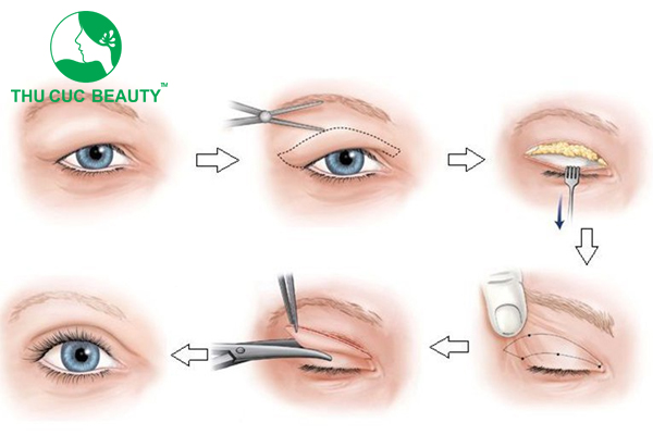 Cắt mí mắt sâu tây cho đôi mắt to tròn, đẹp tự nhiên