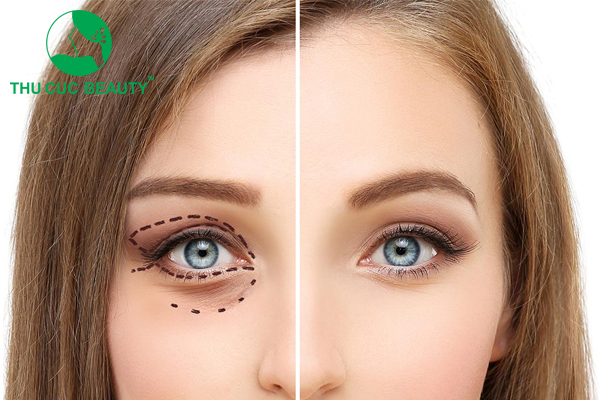 Nhấn mí và cắt mí khác nhau như nào? Phương pháp nào tốt hơn?