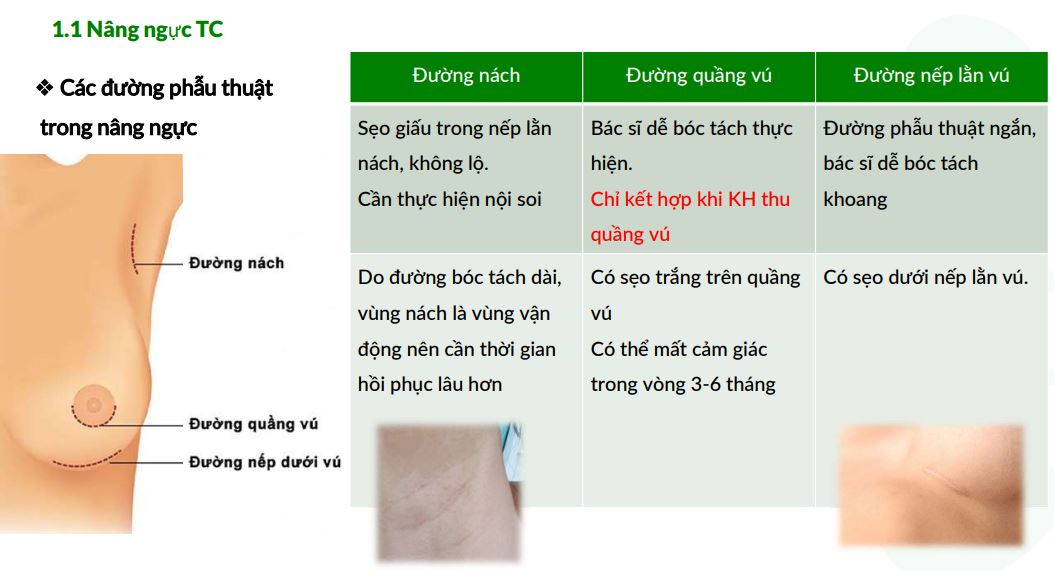 các đường phẫu thuật trong nâng ngực TC