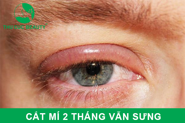 Cắt mí 2 tháng vẫn sưng: Nguyên nhân và giải pháp