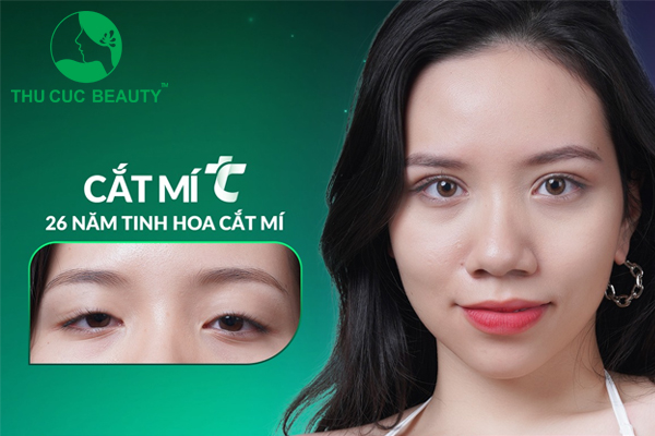 Cắt mí mắt giữ được bao lâu?