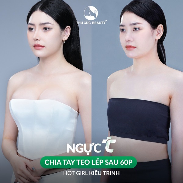 Hình ảnh trước và sau nâng ngực