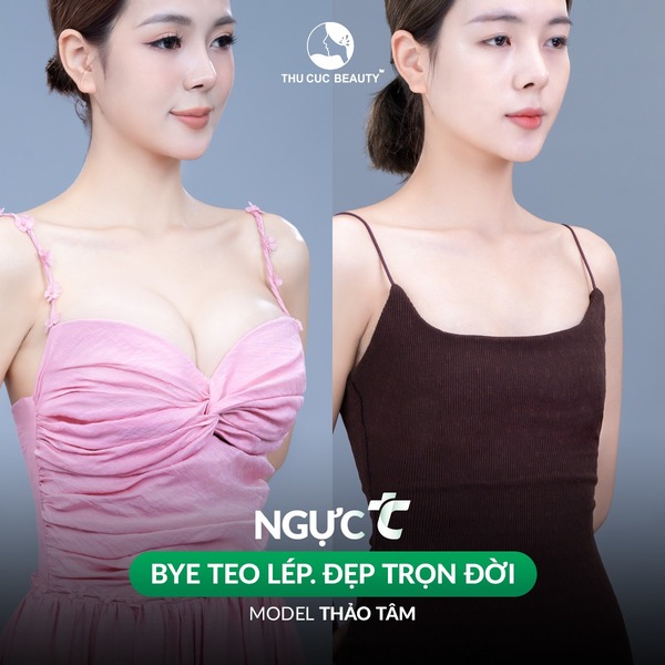 Hình ảnh trước và sau nâng ngực