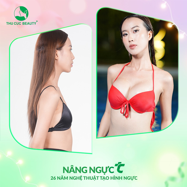 Nâng ngực bao lâu thì mềm?