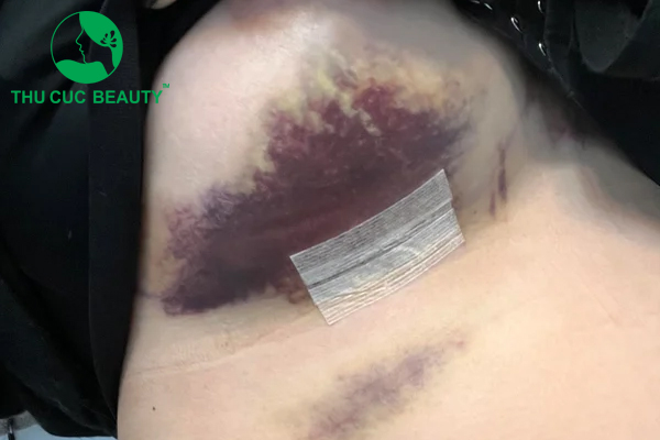 Nâng ngực bị hỏng 