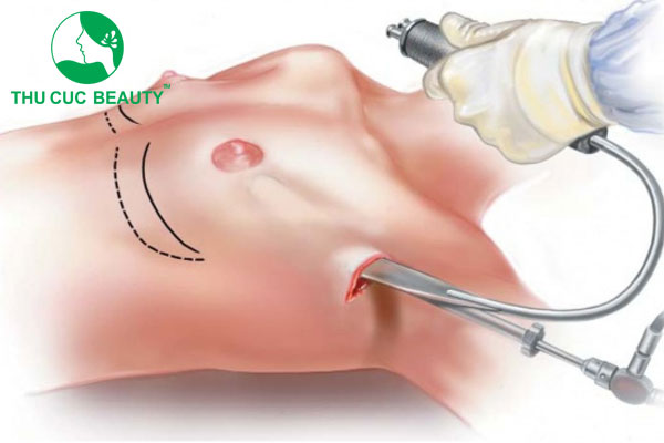 Nâng ngực đường nào tốt nhất?