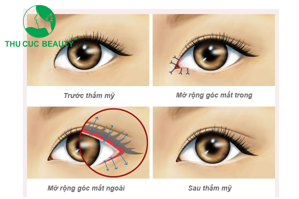 Những điều cần biết về phẫu thuật mắt to