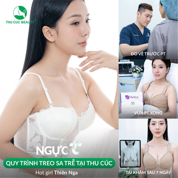 quy trình treo sa trễ