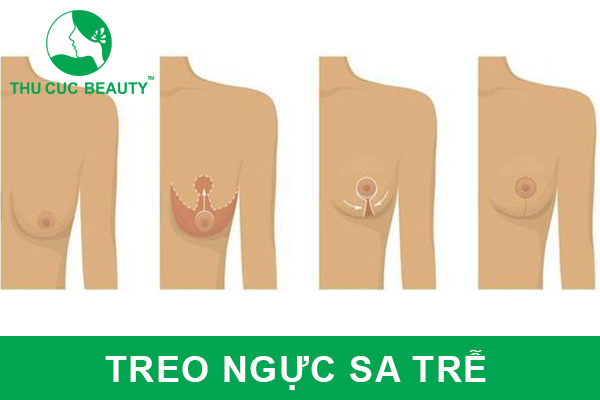 Treo ngực sa trễ có đau không?