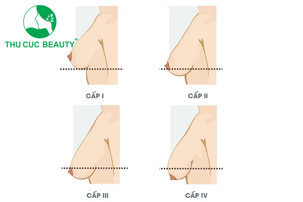 Vú xệ: Nguyên nhân và cách khắc phục
