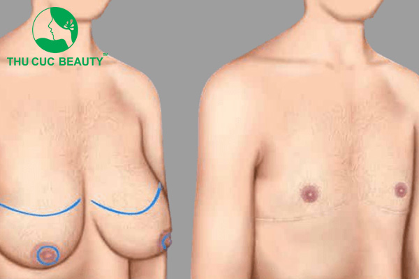 Cắt ngực chuyển giới và những điều cần chú ý