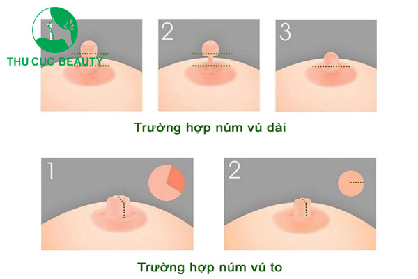 Phẫu thuật thu nhỏ đầu vú