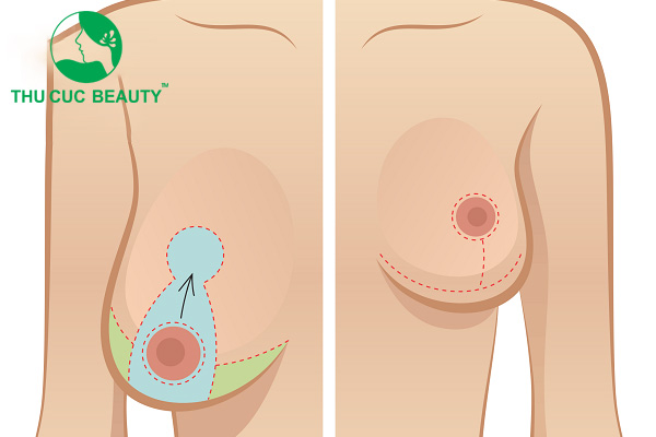 Giải đáp: Nâng ngực chảy xệ giá bao nhiêu?