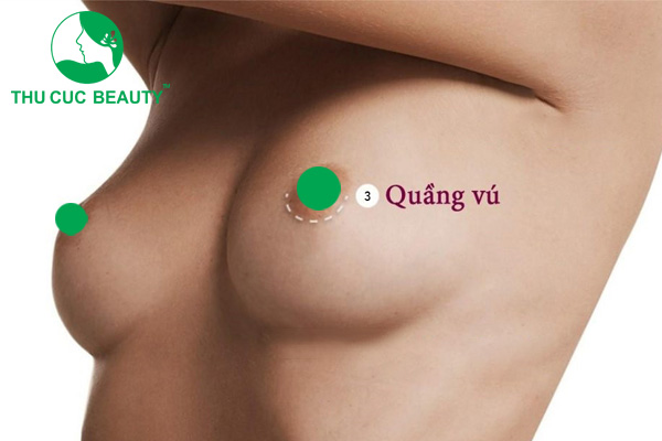 Nâng ngực đường quầng có bị mất cảm giác không?