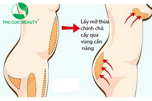 Có những rủi ro gì liên quan đến việc nâng cấp vòng 1 không phẫu thuật?
