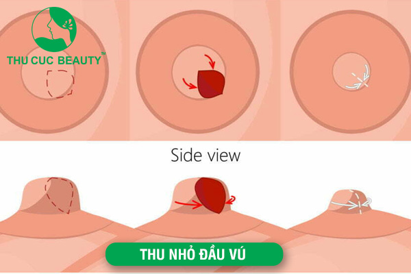 Phẫu thuật thu nhỏ núm vú