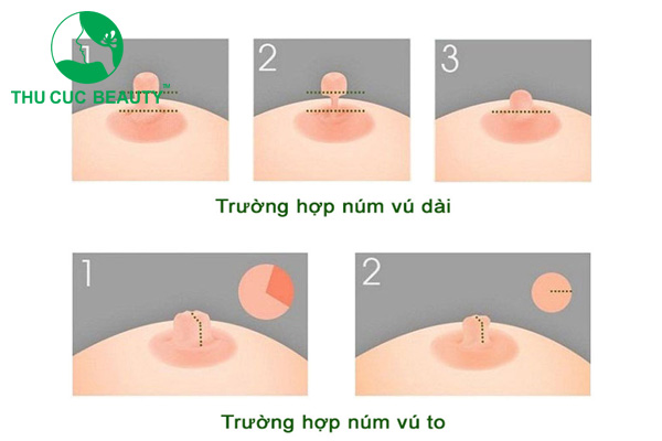 Thu nhỏ nhũ hoa có nguy hiểm không?